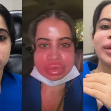 ઉર્ફી જાવેદના હોઠના ઇન્જેક્શન બાદ મોં સોજાઈ ગયું, સોશિયલ મીડિયા પર વીડિયો વાયરલ